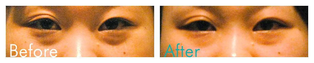 顔のたるみ解消は リガメント がカギ 話題のリガメントほぐしって